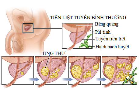 Bài tập cải thiện thể chất và tinh thần cho người bệnh ung thư tuyến tiền liệt- Ảnh 1.