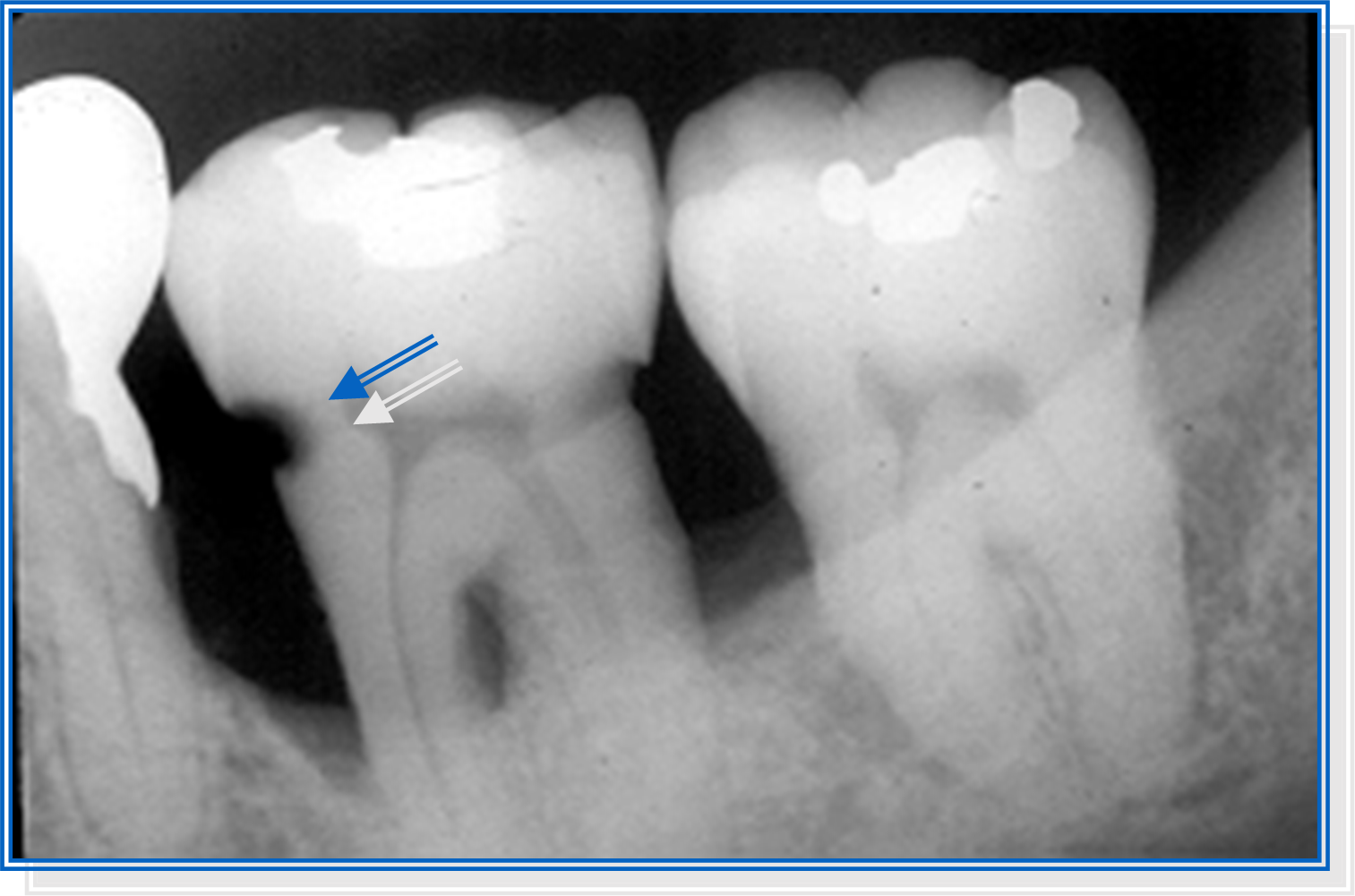 Các phương pháp điều trị sâu răng- Ảnh 2.