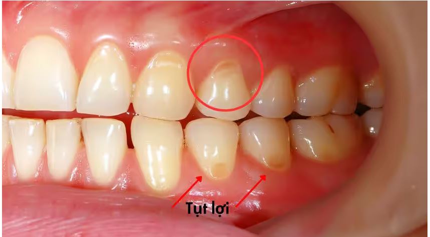 Tụt lợi có chữa được không?- Ảnh 1.