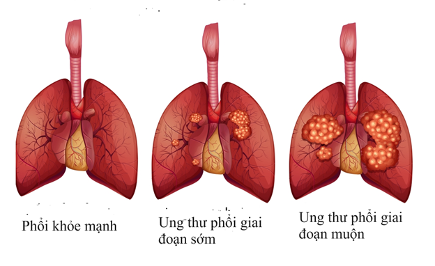 Các lựa chọn điều trị ung thư phổi- Ảnh 2.