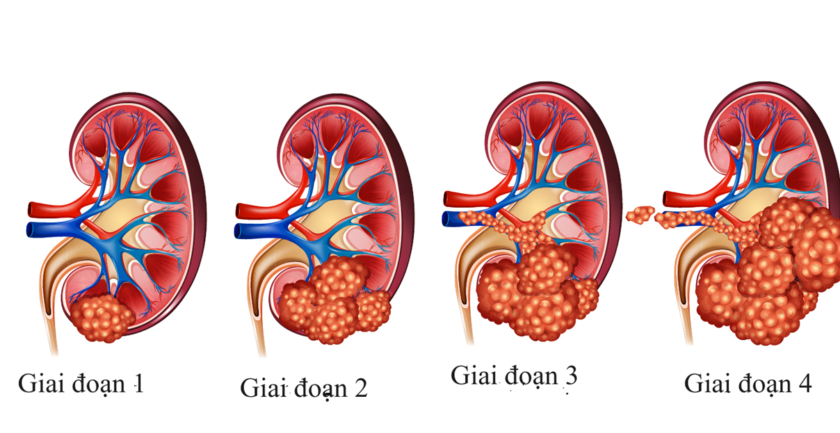 Các lựa chọn điều trị ung thư thận- Ảnh 2.