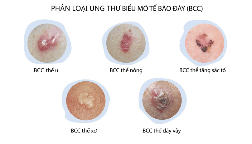 Các phương pháp điều trị ung thư da- Ảnh 1.