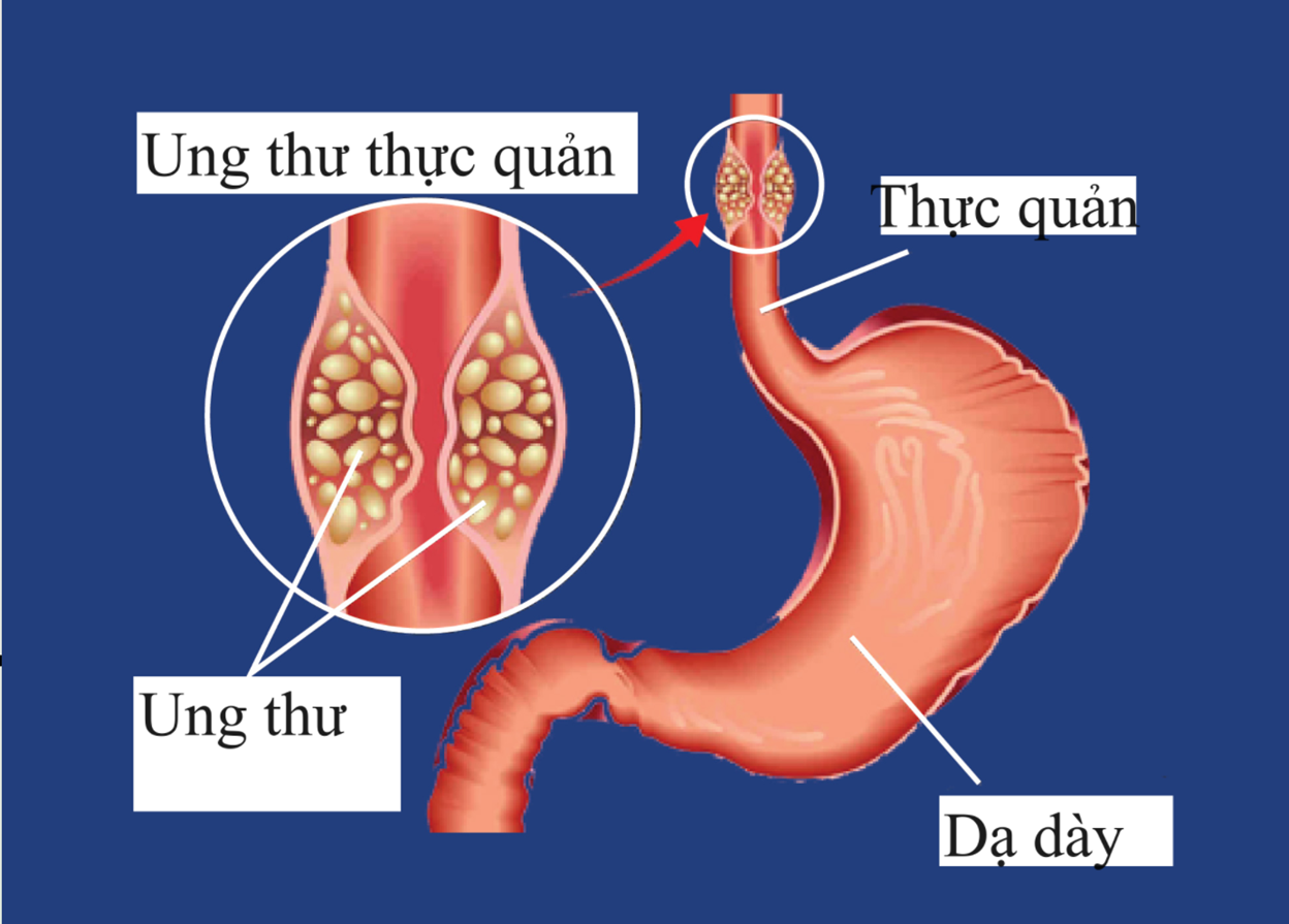 Các loại thuốc điều trị ung thư thực quản- Ảnh 2.