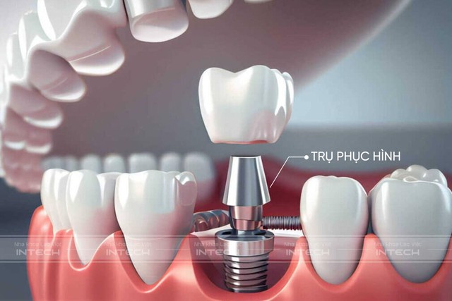 Chủ đề: Cùng tìm hiểu về trụ phục hình giải phẫu cá nhân hóa trong trồng răng implant công nghệ mới- Ảnh 1.