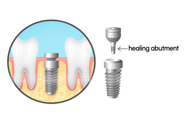 Trồng răng implant công nghệ mới: Tại sao phải sử dụng trụ lành thương giải phẫu cá nhân hóa?- Ảnh 1.