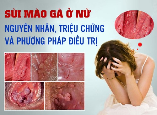 Bệnh sùi mào gà ở nữ giới: Nguyên nhân, dấu hiệu cách chữa- Ảnh 1.