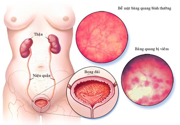 Viêm bàng quang cấp có nguy hiểm không?- Ảnh 1.