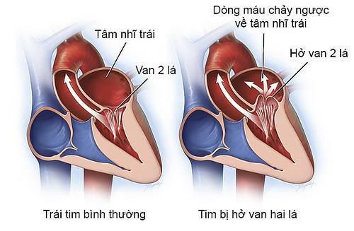 Hở van tim hai lá có nguy hiểm không?- Ảnh 2.