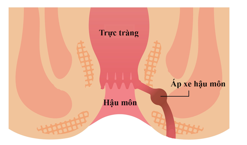 Điều trị áp xe hậu môn- Ảnh 2.