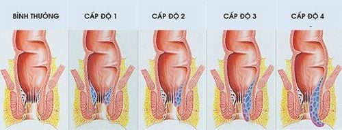 Tỷ lệ người mắc bệnh trĩ hiện nay ngày càng tăng, nguyên nhân phần lớn đến từ chế độ ăn uống và thói quen gây hại trong cuộc sống, ít vận động....