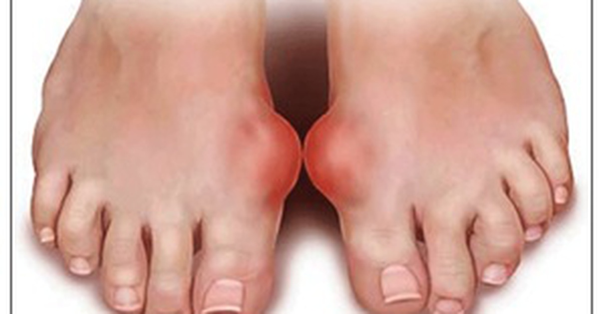 5 lý do khiến bạn dễ mắc gout- Ảnh 1.