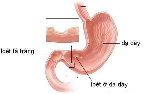 Quá trình viêm dạ dày diễn tiến chậm qua nhiều năm, qua nhiều giai đoạn trung gian với sự biến đổi tế bào của lớp áo phủ bên trong dạ dày trước khi hình thành ung thư dạ dày. Ảnh minh họa