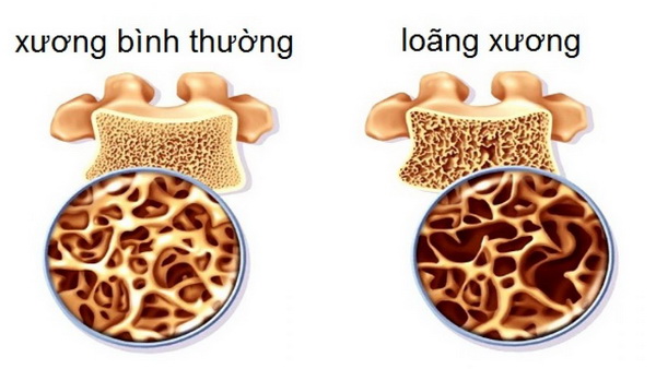 Loãng xương sớm chẳng chừa ai