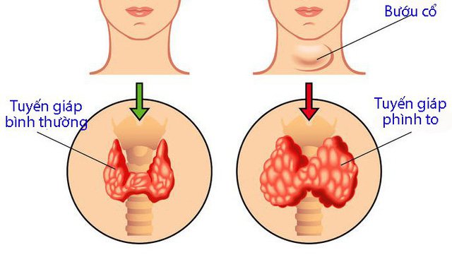 Bướu cổ có mấy loại? Các phương pháp điều trị bướu cổ hiện nay