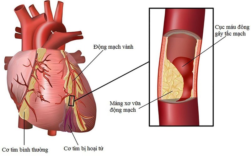 Nhồi máu cơ tim khác gì đột quỵ về nguyên nhân triệu chứng - Công Ty Cổ  Phần Y Tế Nha Trang UNI CARE