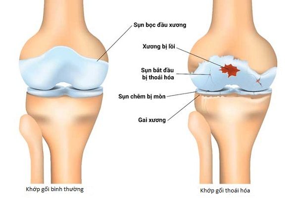 Các phương pháp điều trị thoái hóa khớp gối- Ảnh 1.