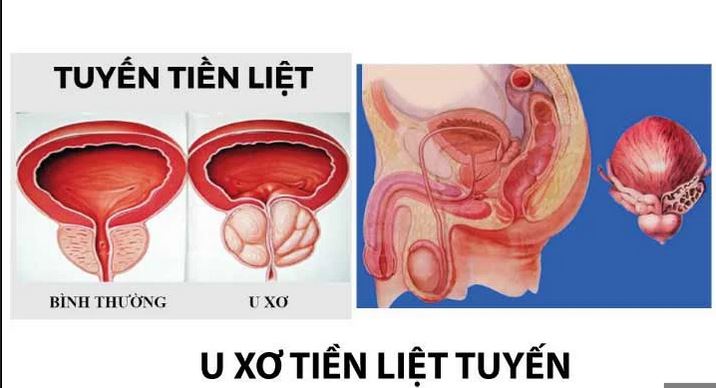 6 cách phòng u xơ tiền liệt tuyến cần biết- Ảnh 1.