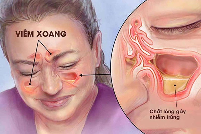 Viêm xoang cấp có nguy hiểm không?- Ảnh 1.