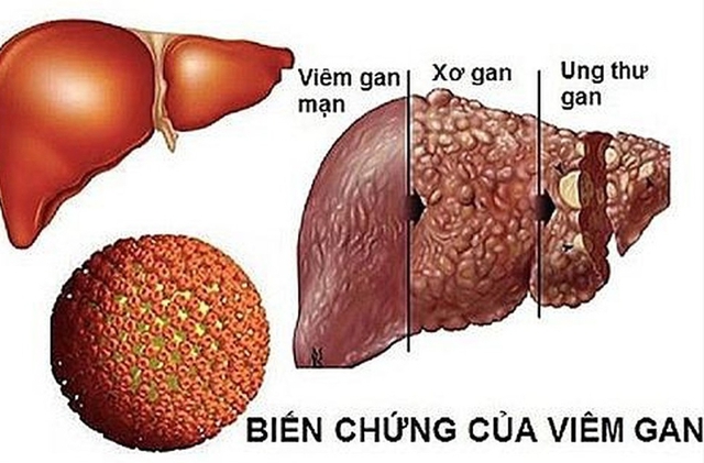 Đối phó với bệnh viêm gan khi mang thai- Ảnh 1.