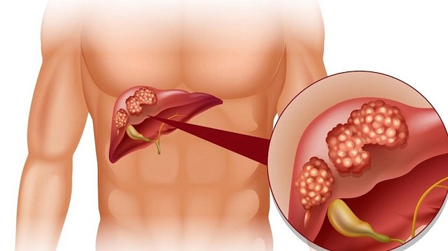 Chức năng gan bị suy giảm là giai đoạn gan bị tổn thương, không làm tròn chức năng của mình sẽ ảnh hưởng đến nhiều cơ quan khác trong cơ thể.