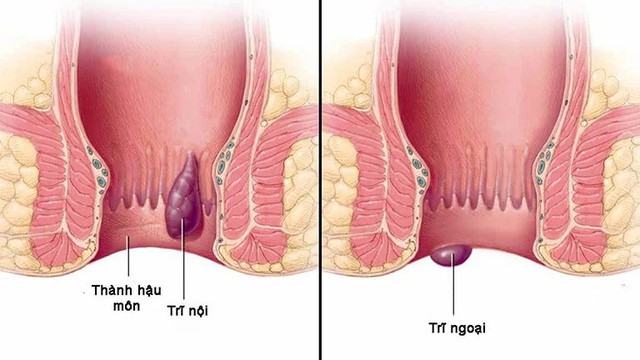 Chế độ ăn cho người mắc bệnh trĩ, nên ăn gì để tốt cho quá trình điều trị?- Ảnh 2.