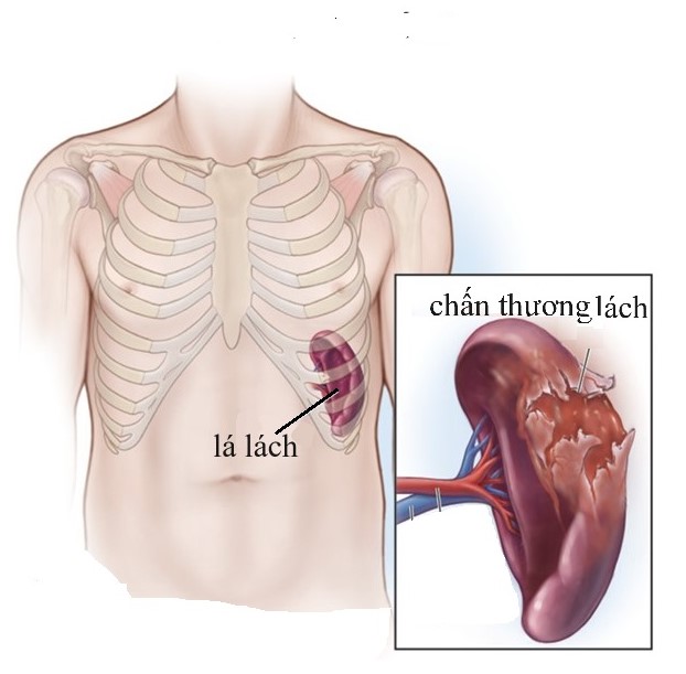 Thuốc và các phương pháp điều trị chấn thương lách- Ảnh 1.