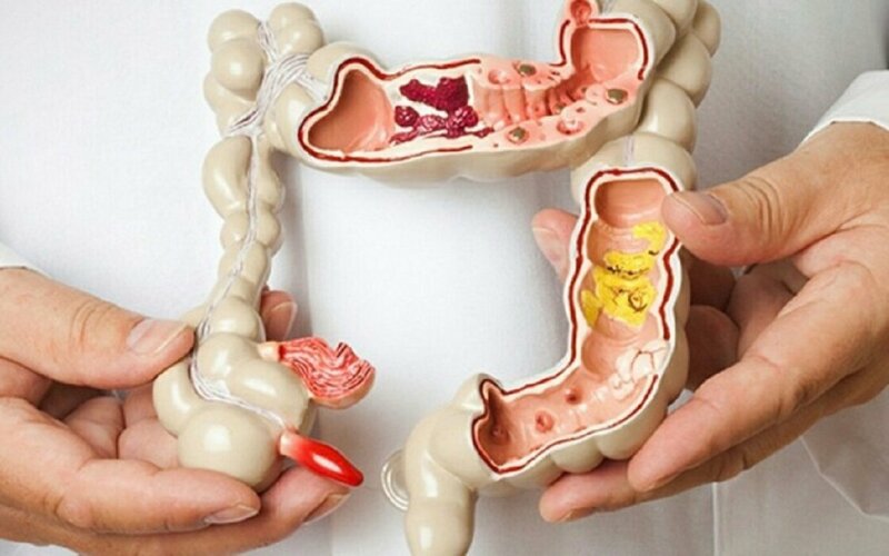 Các phương pháp điều trị bệnh Crohn- Ảnh 1.