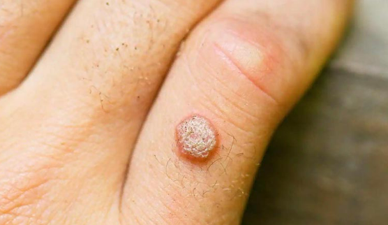 Mẹo dân gian trị mụn cóc- Ảnh 1. Mẹo dân gian trị mụn cóc- Ảnh 1.