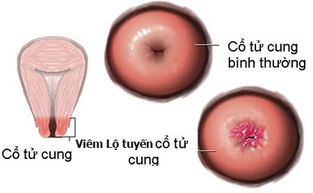 Làm sao để biết có bị viêm lộ tuyến cổ tử cung?- Ảnh 1.