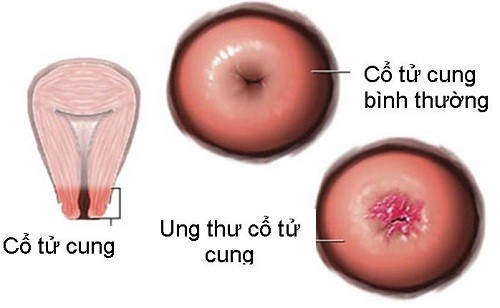 Hình ảnh ung thư cổ tử cung biến chứng nguy hiểm | BvNTP