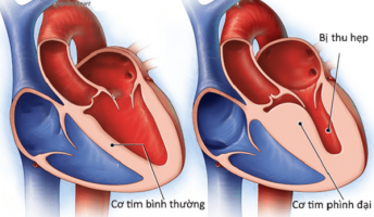 cơ tim phì đại