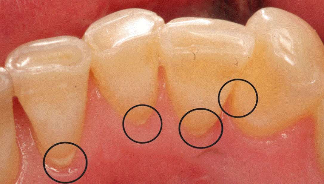 7 biện pháp loại bỏ cao răng tại nhà- Ảnh 1.