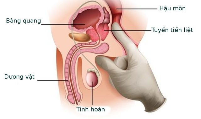 Ung thư tuyến tiền liệt có phòng ngừa được không?- Ảnh 1.