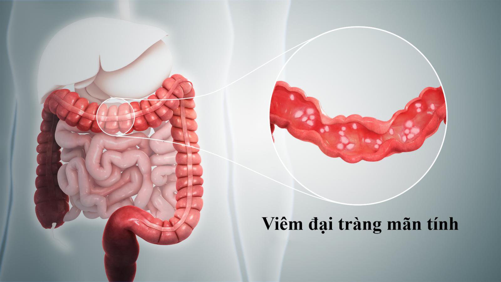 Các phương pháp điều trị viêm đại tràng mạn tính- Ảnh 1.