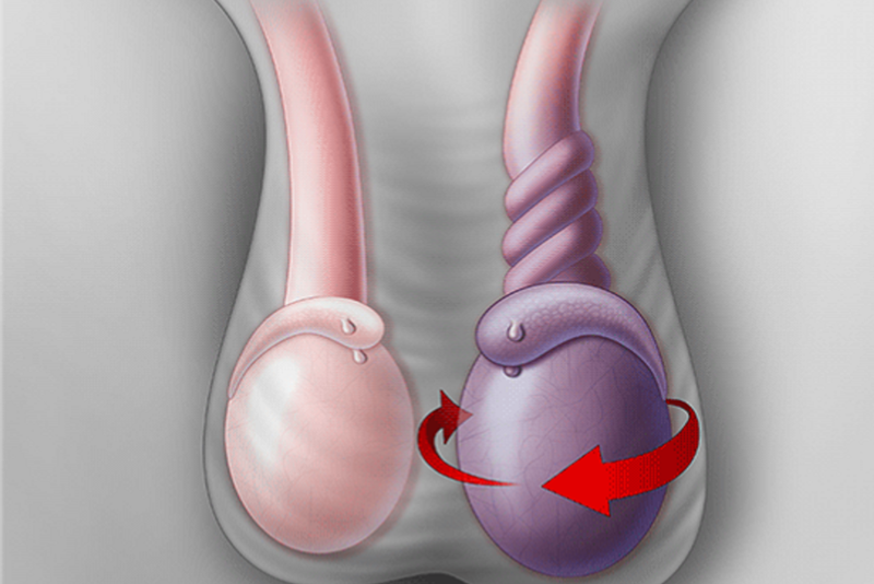 Xoắn tinh hoàn cần cấp cứu sớm trong 6 giờ đầu, tránh nguy cơ bị hoại tử - Ảnh 2.