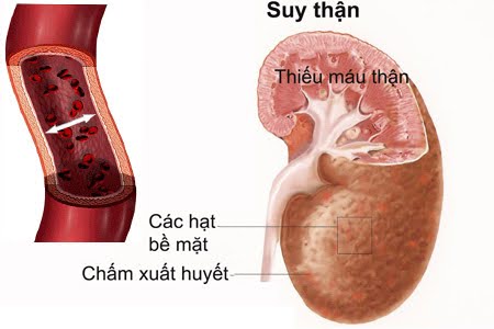 Có nên sử dụng insulin sớm để ngăn ngừa suy thận ở người đái tháo đường?- Ảnh 1.