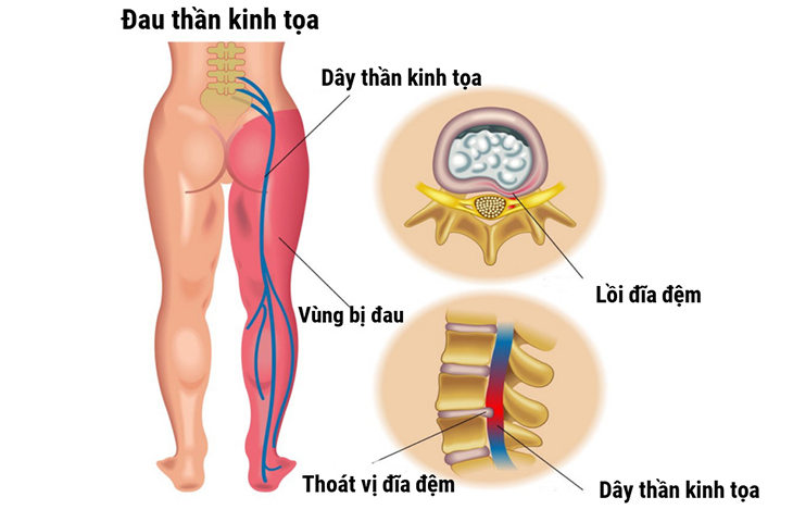 Chữa đau thần kinh tọa hiệu quả- Ảnh 1.