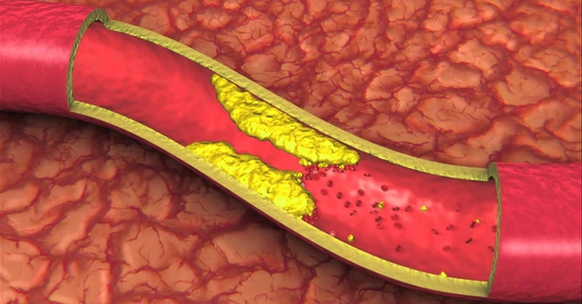 Mỡ máu hay còn gọi là lipid máu là chất béo có trong máu, bao gồm cholesterol và chất béo trung tính - Triglyceride.