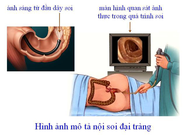 Nên nội soi đại tràng định kỳ bao lâu một lần?- Ảnh 1.