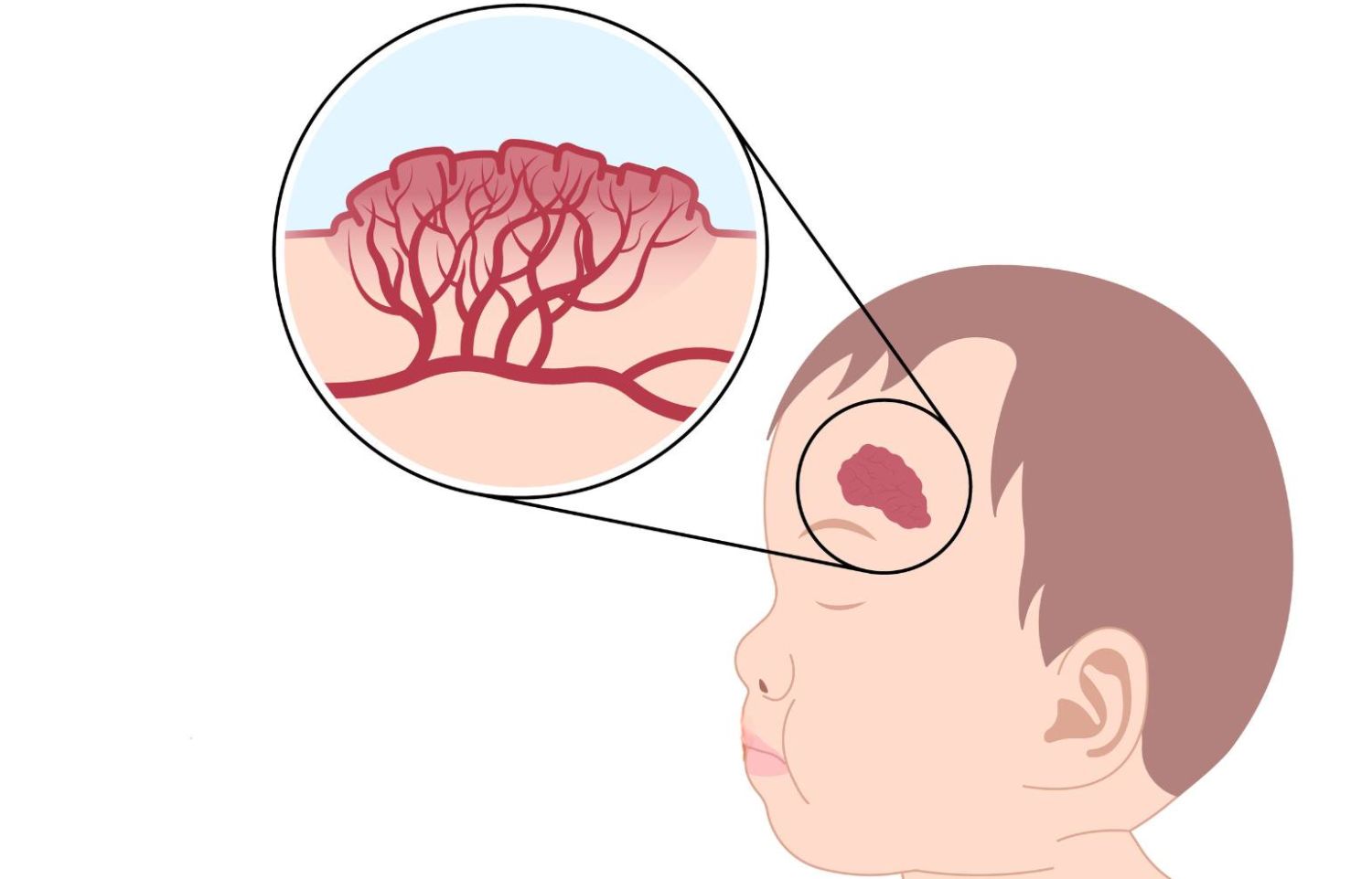 Người bị u máu cần chú ý gì về dinh dưỡng?- Ảnh 1.