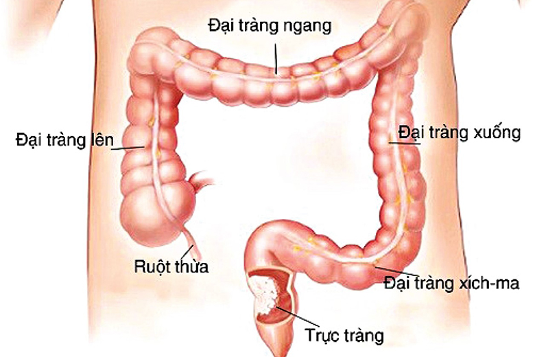 Viêm đại tràng: Nguyên nhân, biểu hiện, cách điều trị và phòng bệnh- Ảnh 1.