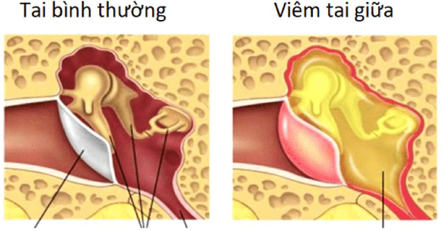 Viêm tai giữa là bệnh lý viêm nhiễm, nếu không được điều trị dứt điểm có thể dẫn đến viêm tai giữa mạn tính.