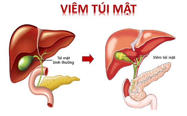 Dấu hiệu của viêm túi mật theo từng giai đoạn- Ảnh 1.