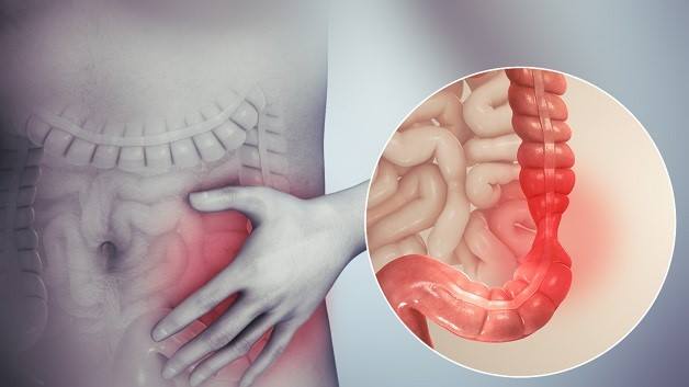 Bệnh viêm ruột gồm hai bệnh mạn tính gây ra là: viêm loét đại tràng và bệnh Crohn.