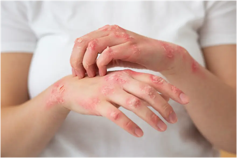 Thuốc điều trị bệnh ghẻ- Ảnh 2. Thuốc điều trị bệnh ghẻ- Ảnh 2.