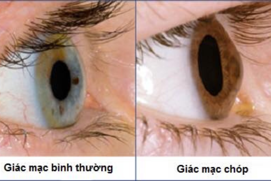 Các câu hỏi thường gặp liên quan đến bệnh giác mạc chóp- Ảnh 1. Các câu hỏi thường gặp liên quan đến bệnh giác mạc chóp- Ảnh 1.