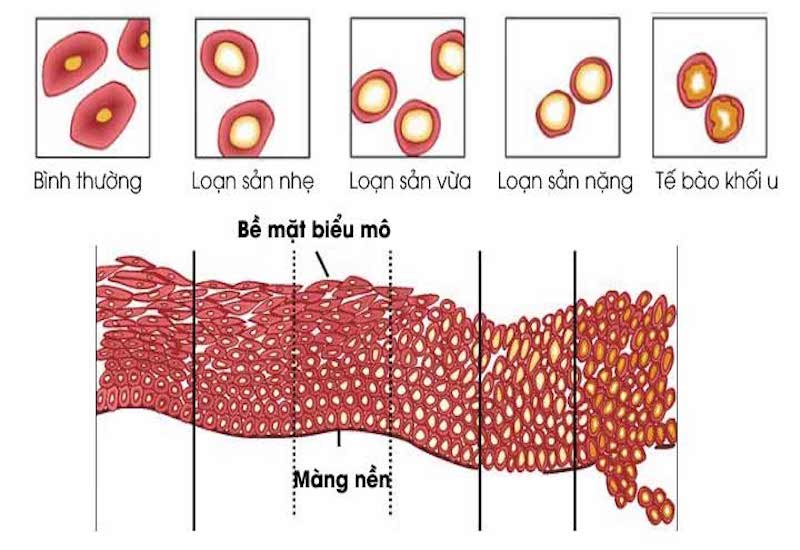 Loạn sản cổ tử cung: Nguyên nhân, triệu chứng, cách điều trị và phòng ngừa- Ảnh 1.