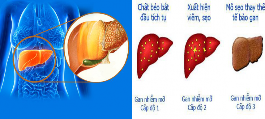 Cải thiện gan nhiễm mỡ hiệu quả tại nhà- Ảnh 1.