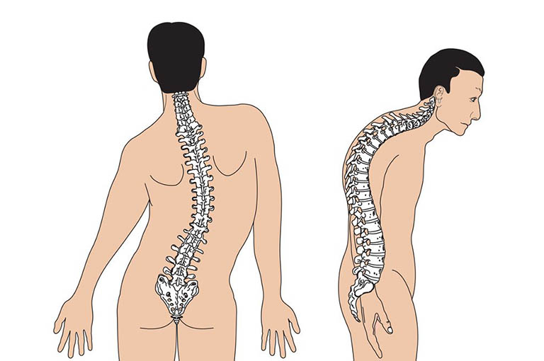 Các biện pháp điều trị gù cột sống- Ảnh 1.