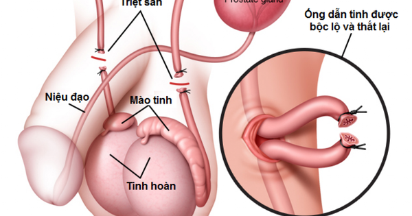 Vợ có bầu sau khi chồng đã thắt ống dẫn tinh